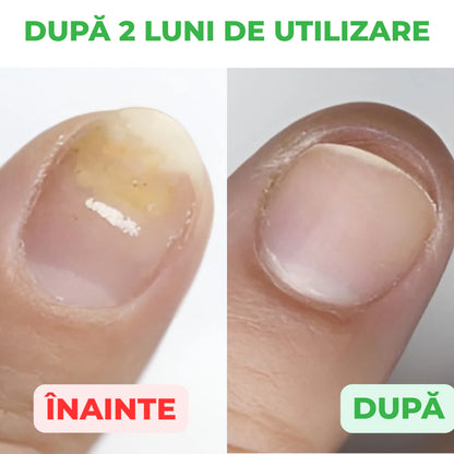 StraDerm Active Care – Gombaellenes és Antibakteriális Kezelés Körmökre és Bőrre 30ml