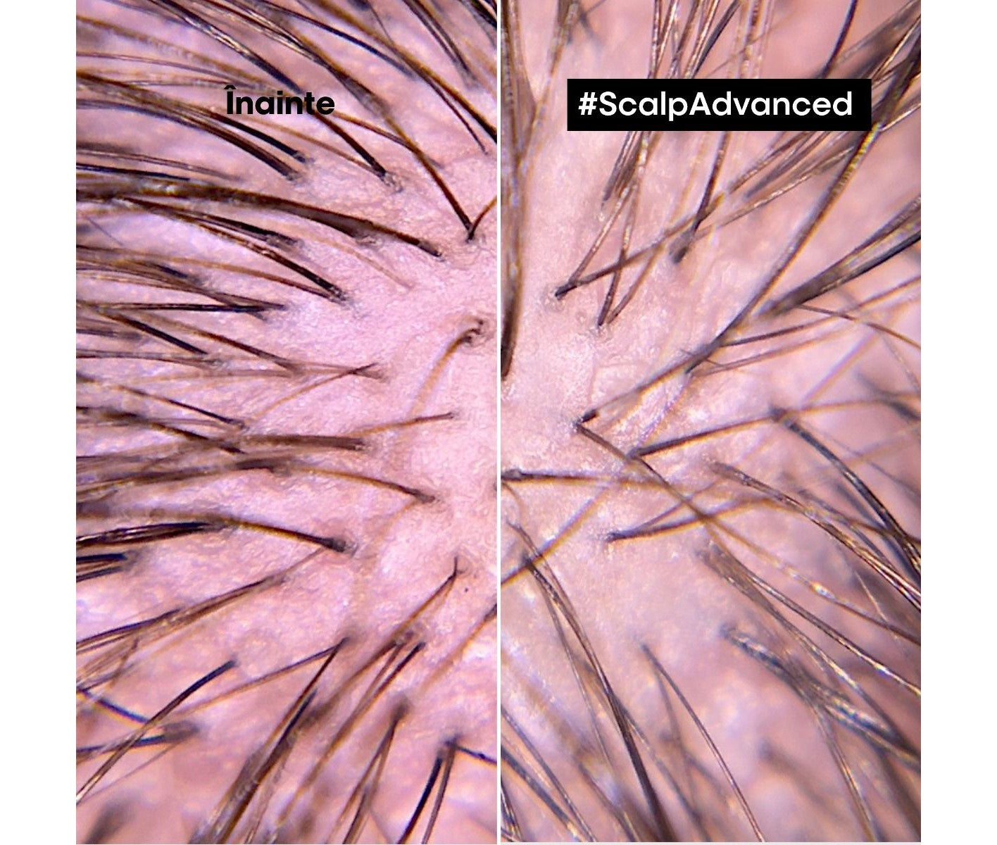 Nyugtató kezelés érzékeny fejbőrre — L'Oréal Professionnel Scalp Advanced 200ml