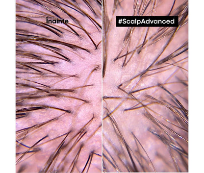 Nyugtató kezelés érzékeny fejbőrre — L'Oréal Professionnel Scalp Advanced 200ml