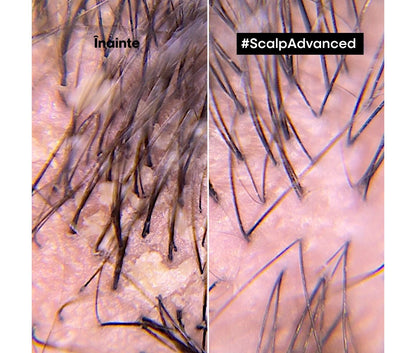 Korpaellenes sampon fejbőrre — L'Oréal Professionnel Scalp Advanced 300ml